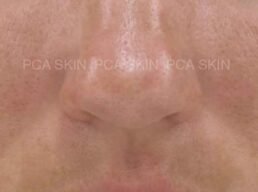 Clear Pore Skin. Close-up of smooth, clear pore skin with minimal imperfections for healthy complexion.