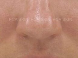 Clear Pore Skin. Close-up of smooth, clear skin with visible pores, showcasing skincare results.